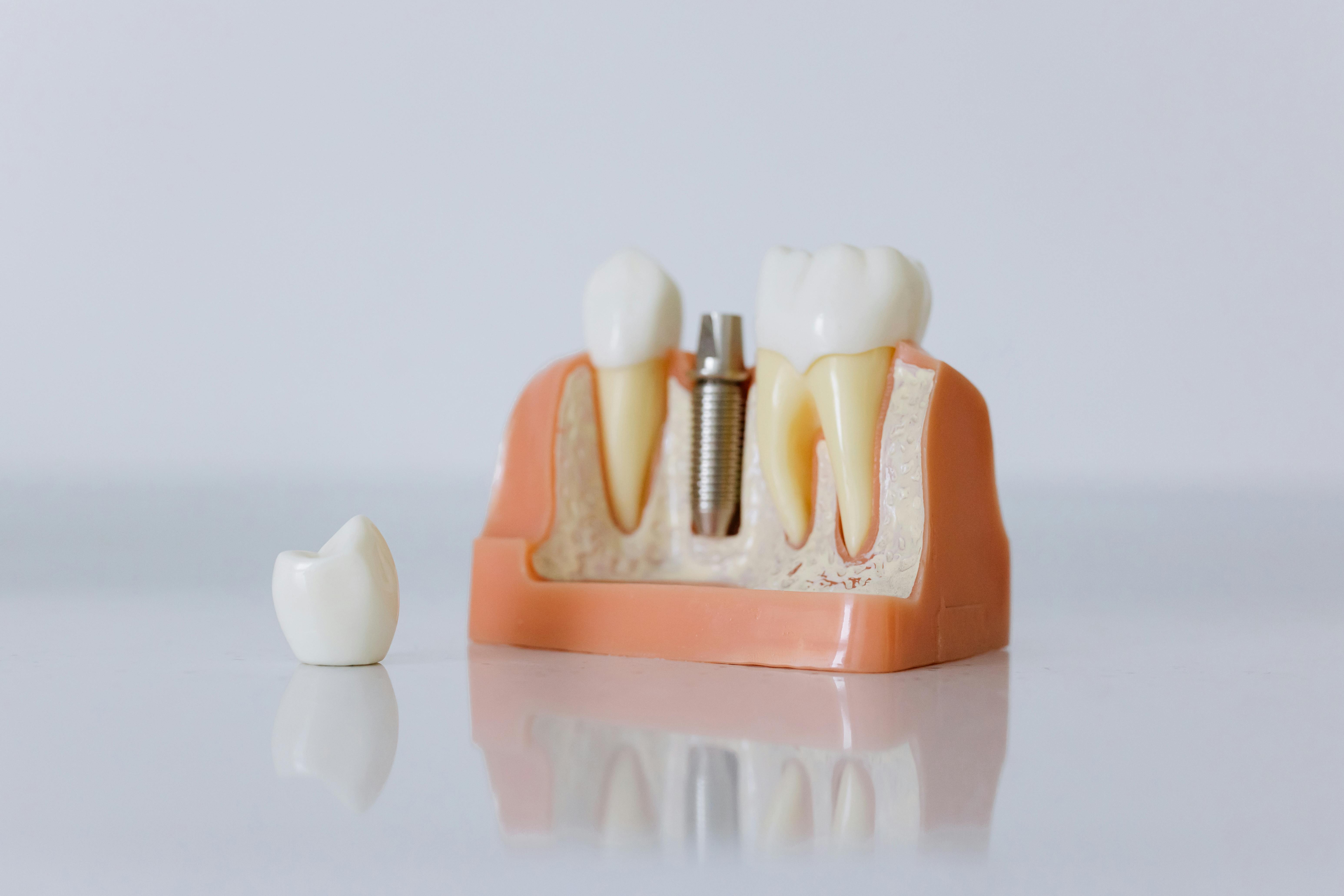 Everything You Need to Know About Dental Implants